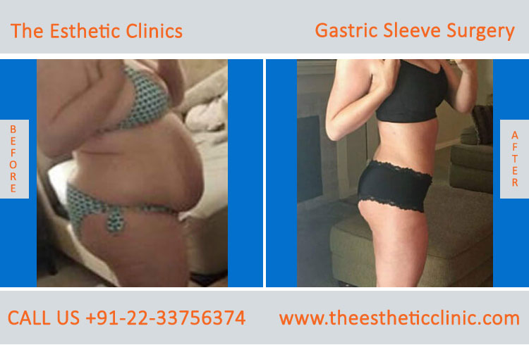 Gastric Sleeve Surgery, bariatric surgery before after photos in mumbai india (3)